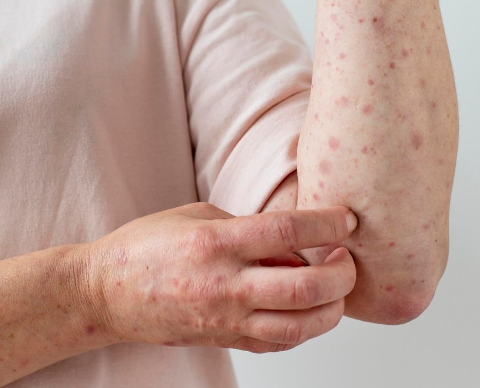 Tick-Borne & Zoonotic Infection Care in Cañon City, CO