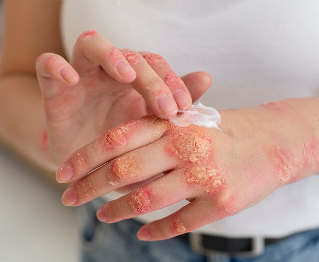 Expert Diagnosis & Treatment for Fungal Infections in Colorado